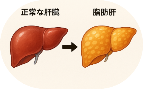 脂肪肝の様子